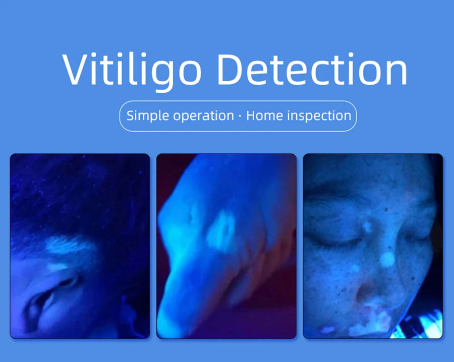 Skin Analyzer Skin Examination Beauty Test Medical Wood's Lamp Dermoscope Medical Woods Lamp Skin Analysis Vitiligo Detector