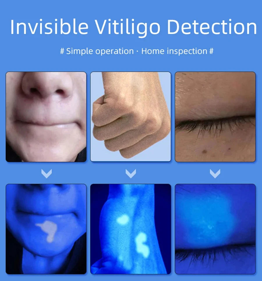 Skin Analyzer Skin Examination Beauty Test Medical Wood's Lamp Dermoscope Medical Woods Lamp Skin Analysis Vitiligo Detector