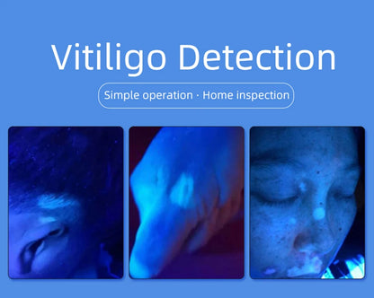 Skin Analyzer Skin Examination Beauty Test Medical Wood's Lamp Dermoscope Medical Woods Lamp Skin Analysis Vitiligo Detector