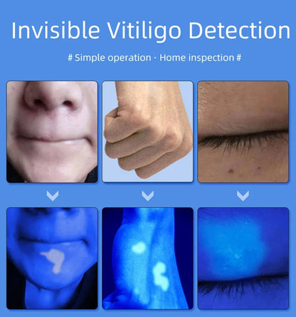 Skin Analyzer Skin Examination Beauty Test Medical Wood's Lamp Dermoscope Medical Woods Lamp Skin Analysis Vitiligo Detector