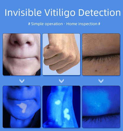 Skin Analyzer Skin Examination Beauty Test Medical Wood's Lamp Dermoscope Medical Woods Lamp Skin Analysis Vitiligo Detector